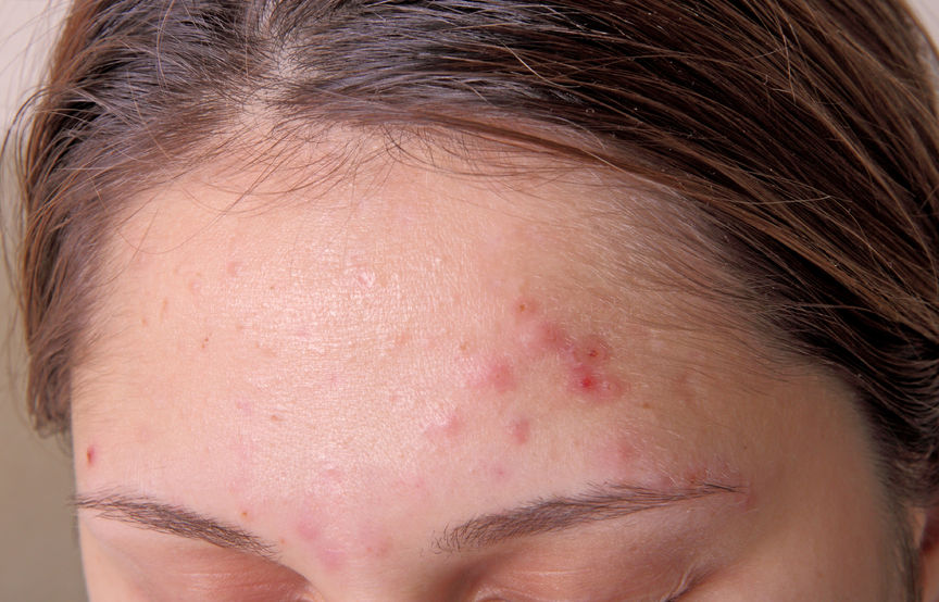 5 Ways to Get Rid of Adult Acne