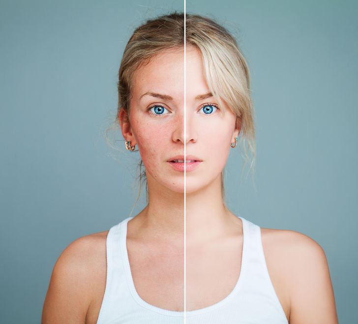 Question and Answer: Any Rosacea Tips?