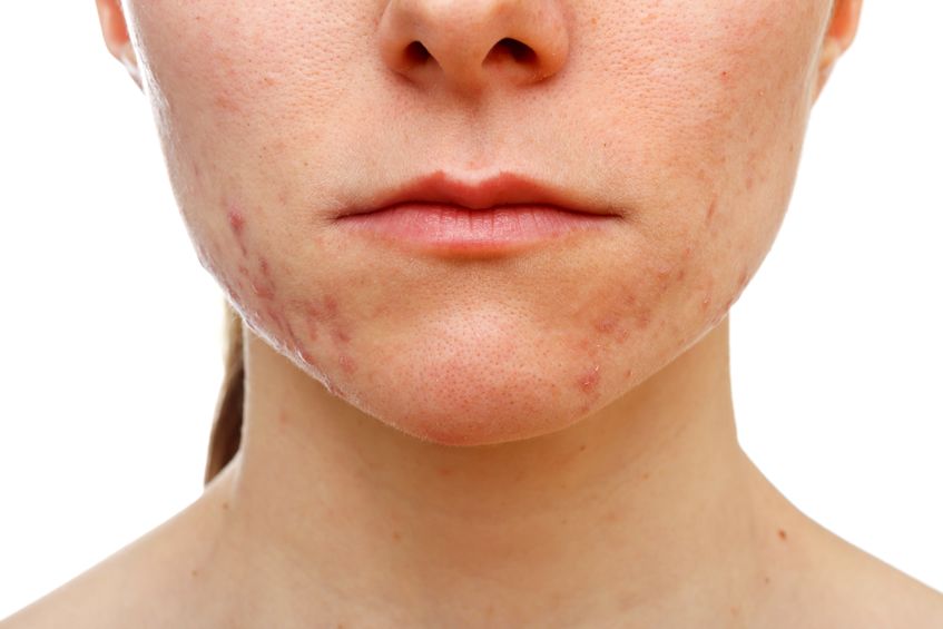 5 No-Nonsense Tips for Reducing Acne Breakouts